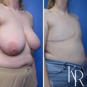 Top surgery before and after photo, side view
