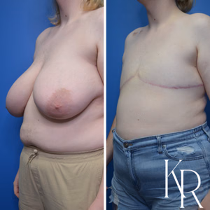 Top surgery before and after photo, front view