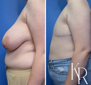 Top surgery before and after photo, side view