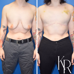 Top surgery before and after photo, front view