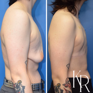 Top surgery before and after photo, side view