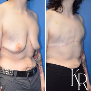 Top surgery before and after photo, side view