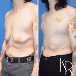 Top surgery before and after photo, front view