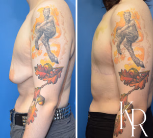 Top surgery before and after photo, side view