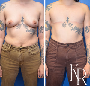 Top surgery before and after photo, front view
