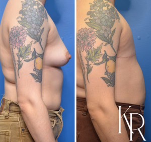 Top surgery before and after photo, side view