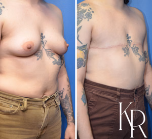 Top surgery before and after photo, front view
