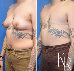 Top surgery before and after photo, front view