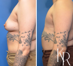 Top surgery before and after photo, side view