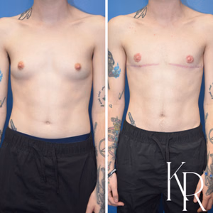 Top surgery before and after photo, front view