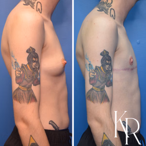 Top surgery before and after photo, side view