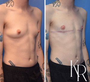 Top surgery before and after photo, side view