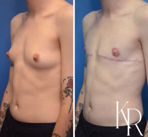 Top surgery before and after photo, front view
