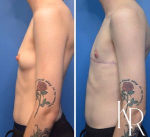 Top surgery before and after photo, side view