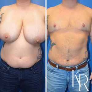 Top surgery before and after photo, front view