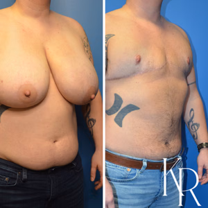 Top surgery before and after photo, front view