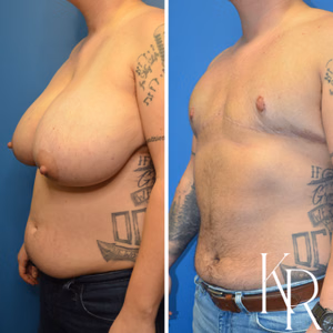 Top surgery before and after photo, oblique view