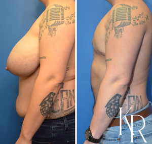 Top surgery before and after photo, side view