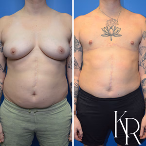 Top surgery before and after photo, front view