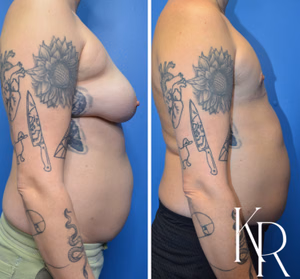 Top surgery before and after photo, side view