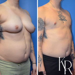 Top surgery before and after photo, front view