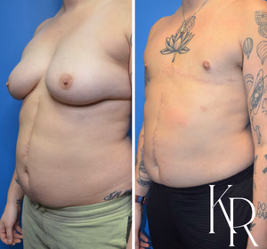 Top surgery before and after photo, oblique view