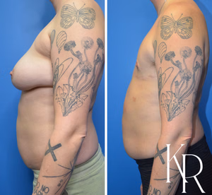 Top surgery before and after photo, side view