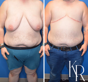 Top surgery before and after photo, front view