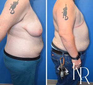 Top surgery before and after photo, side view