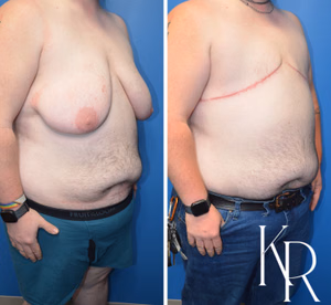 Top surgery before and after photo, front view