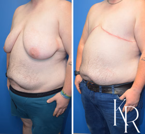 Top surgery before and after photo, oblique view