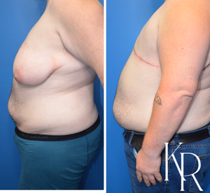 Top surgery before and after photo, side view