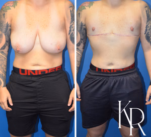 Top surgery before and after photo, front view