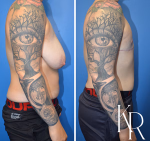 Top surgery before and after photo, side view