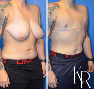 Top surgery before and after photo, front view