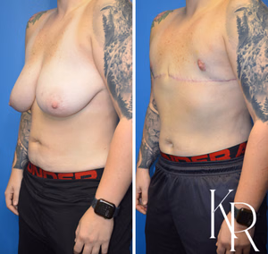 Top surgery before and after photo, oblique view