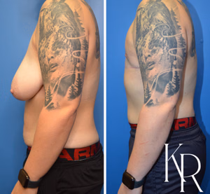 Top surgery before and after photo, side view