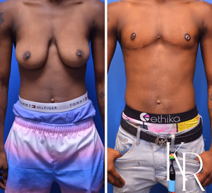 Top surgery before and after photo, front view