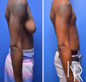 Top surgery before and after photo, side view