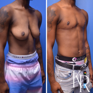 Top surgery before and after photo, front view