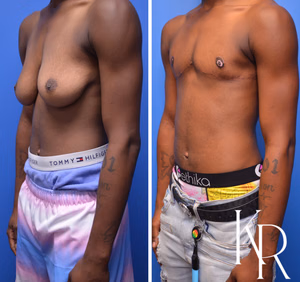 Top surgery before and after photo, oblique view