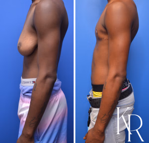 Top surgery before and after photo, side view