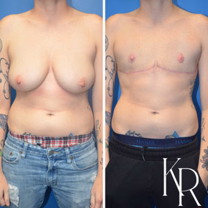 Top surgery before and after photo, front view