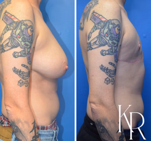 Top surgery before and after photo, side view