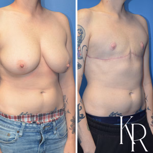 Top surgery before and after photo, front view