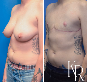 Top surgery before and after photo, oblique view