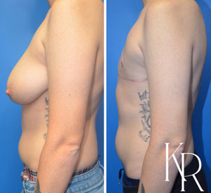 Top surgery before and after photo, side view