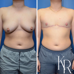 Top surgery before and after photo, front view