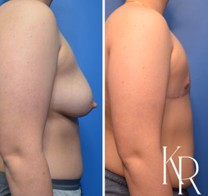 Top surgery before and after photo, side view