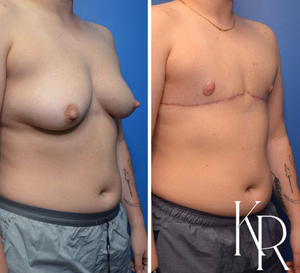 Top surgery before and after photo, front view
